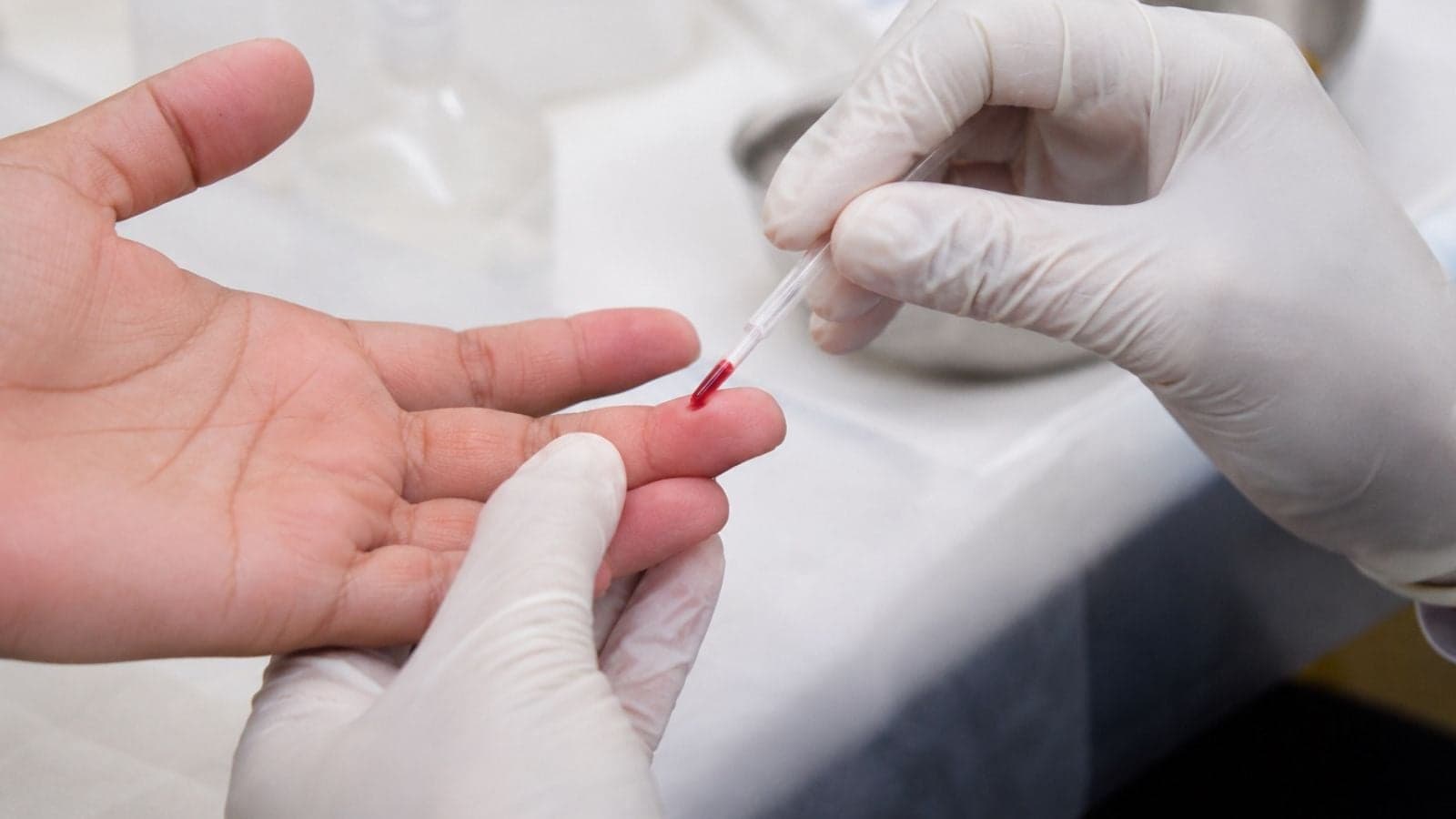 Julho Amarelo amplia ações contra hepatites em Jundiaí